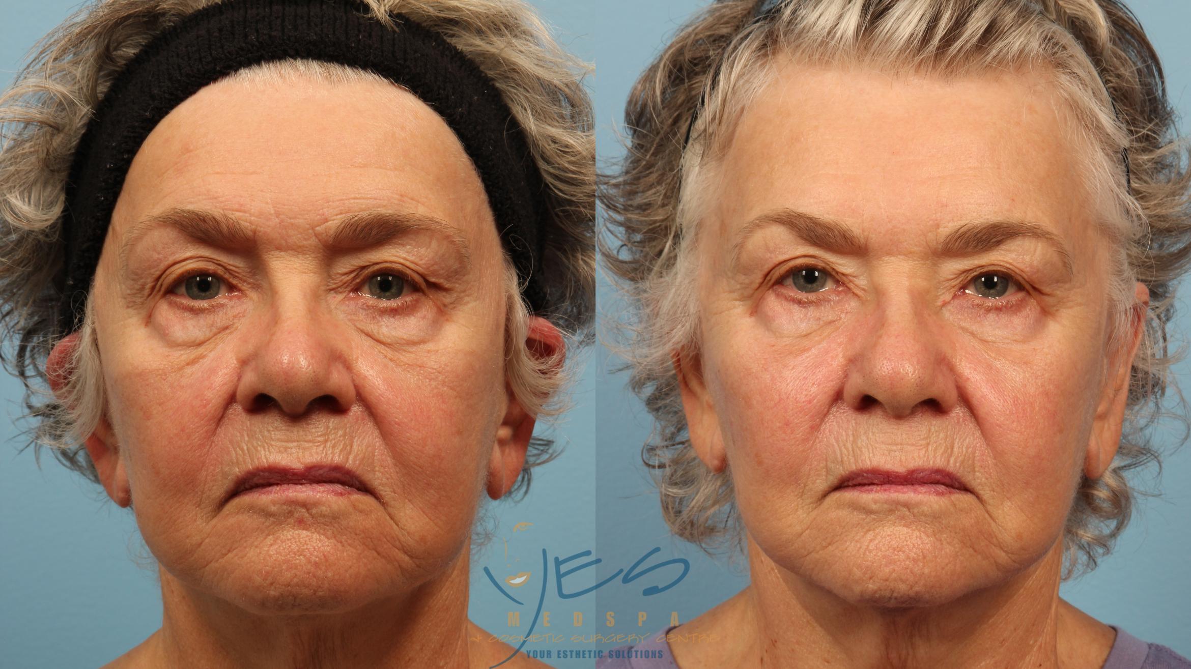 BOTOX COSMETIC® Treatments Case 357 Before & After Front | Vancouver, BC | YES Medspa & Cosmetic Surgery Centre