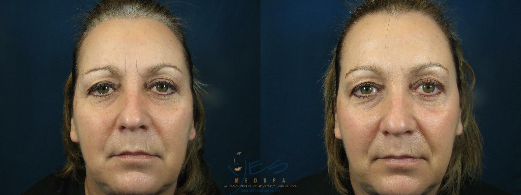Before & After BOTOX COSMETIC® Treatments Case 80 At Rest View in Vancouver, BC