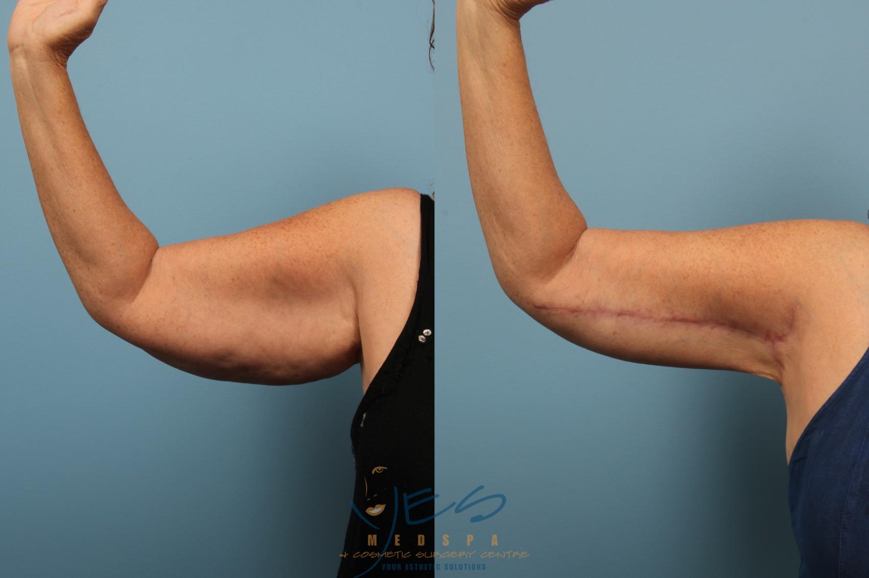 Brachioplasty Case 148 Before & After Front | Vancouver, BC | YES Medspa & Cosmetic Surgery Centre