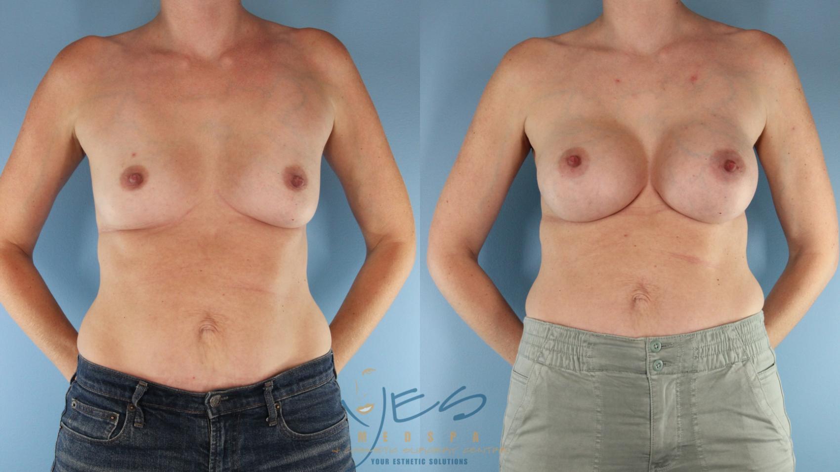 Before & After Breast Augmentation Case 568 Front View in Vancouver, BC