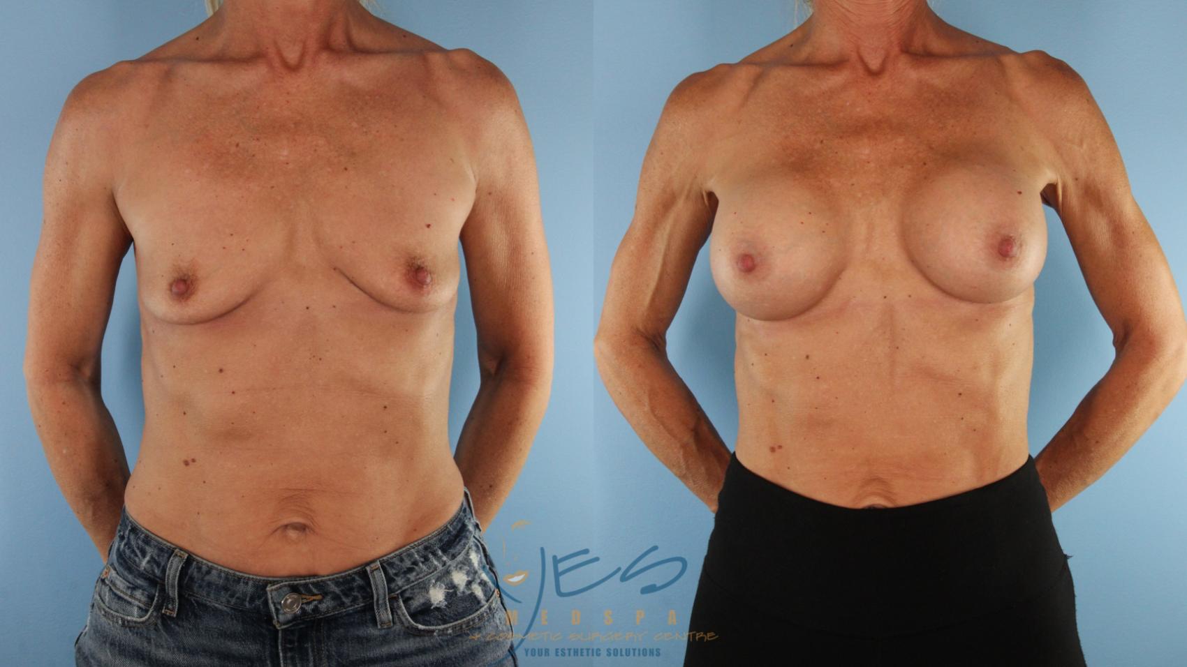 Before & After Breast Augmentation Case 569 Front View in Vancouver, BC