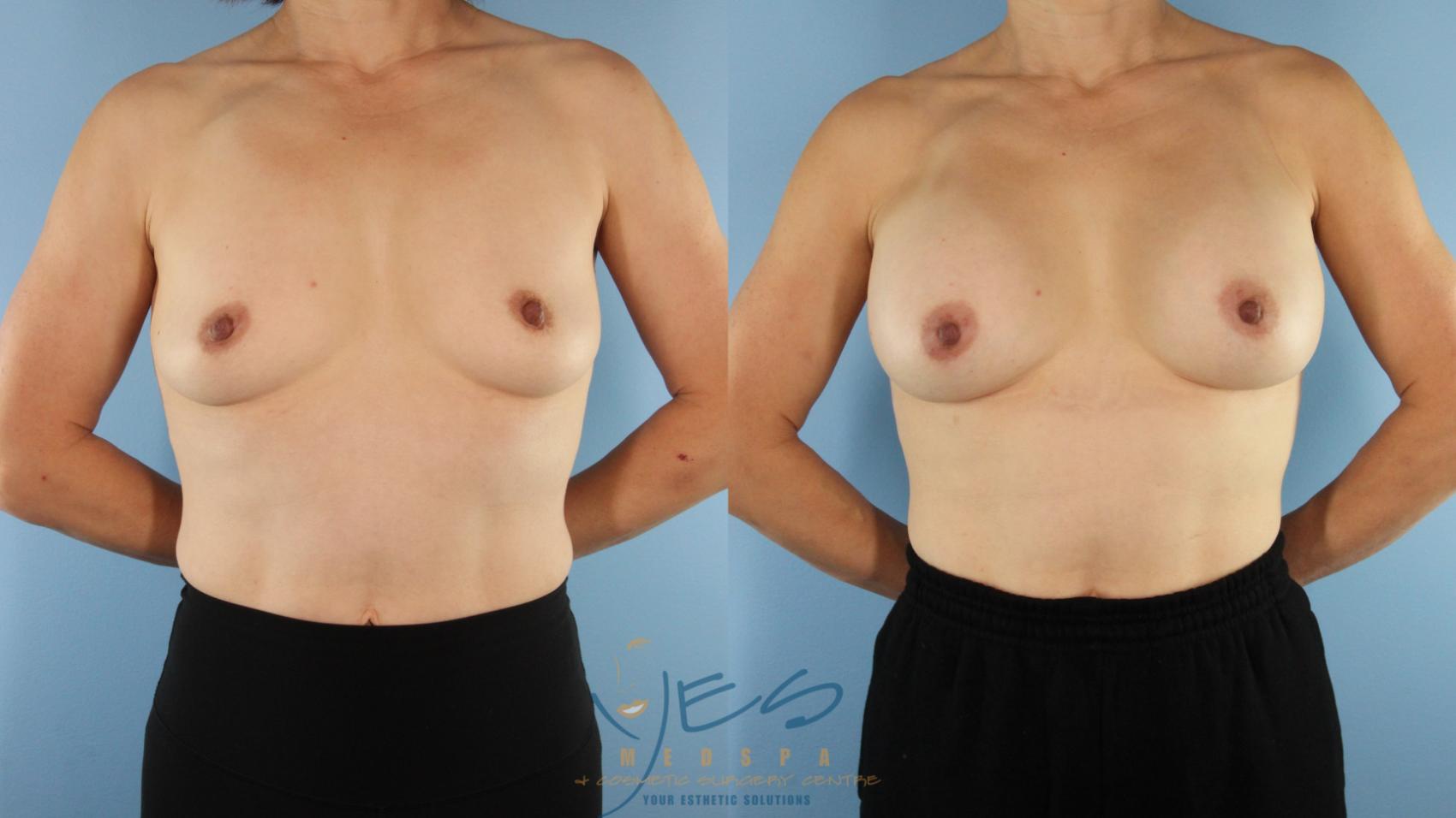 Before & After Breast Augmentation Case 571 Front View in Vancouver, BC