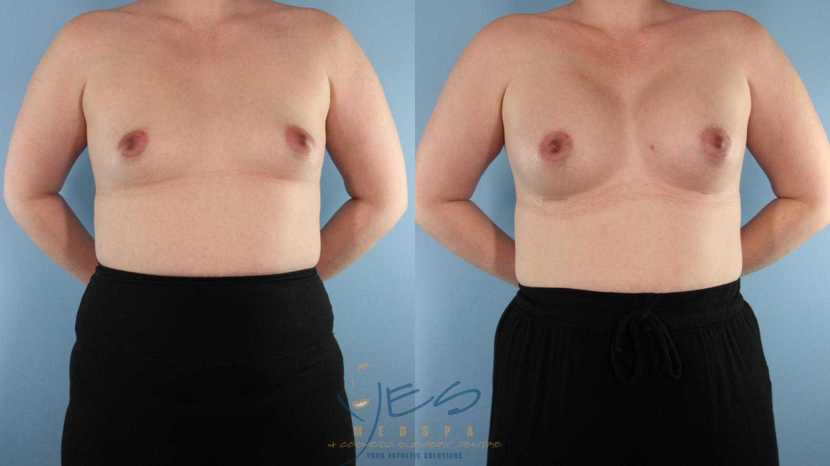 Before & After Breast Augmentation Case 573 Front View in Vancouver, BC