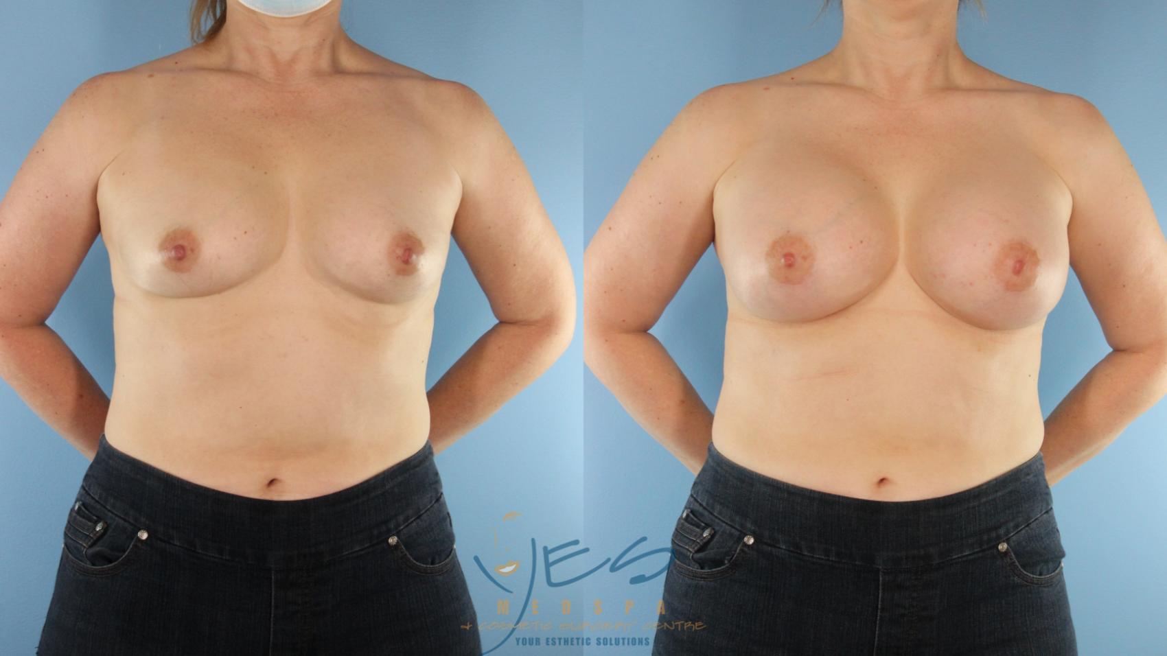 Before & After Breast Augmentation Case 574 Front View in Vancouver, BC