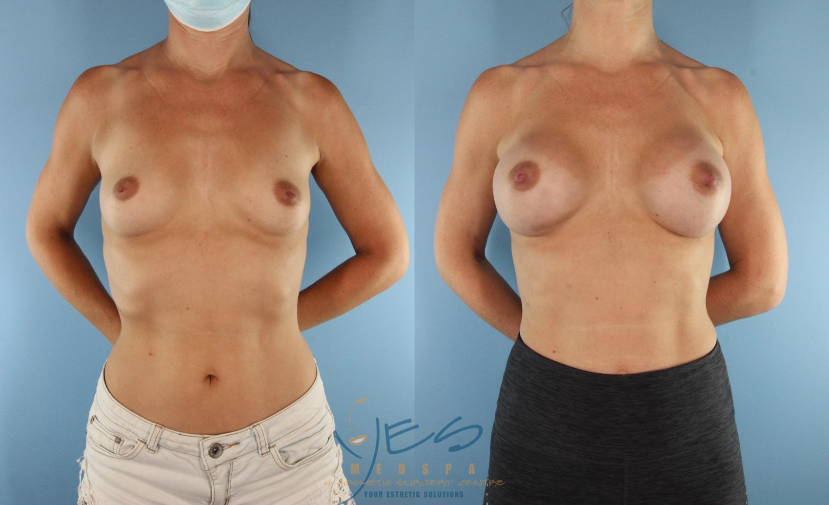Before & After Breast Augmentation Case 575 Front View in Vancouver, BC