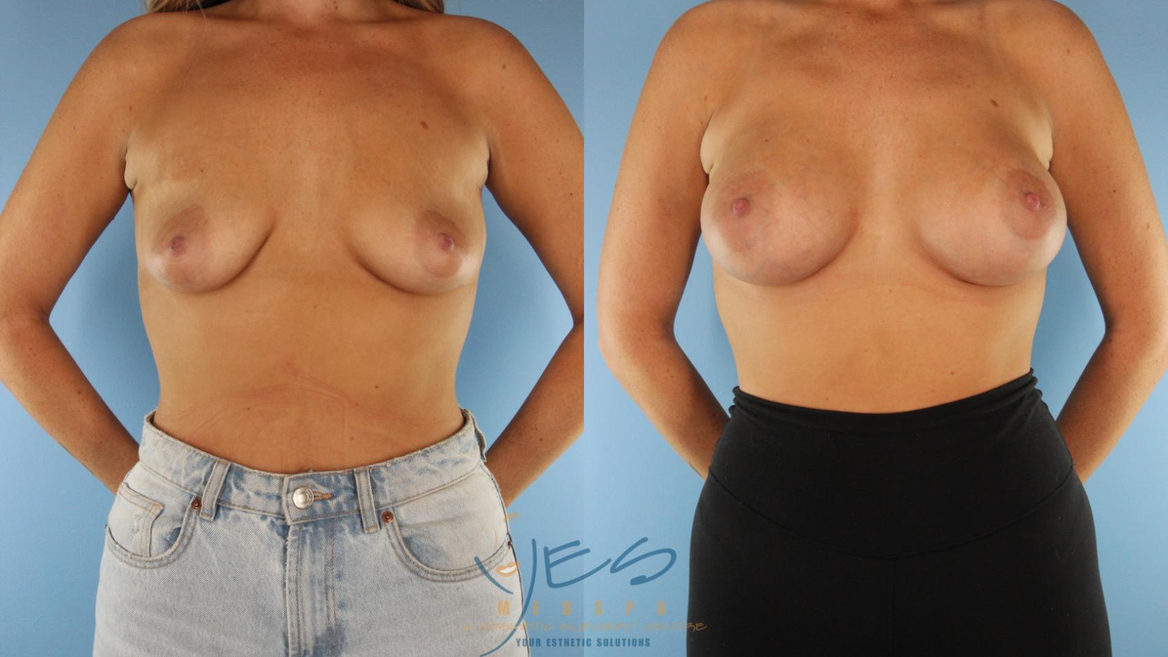 Before & After Breast Augmentation Case 576 Front View in Vancouver, BC