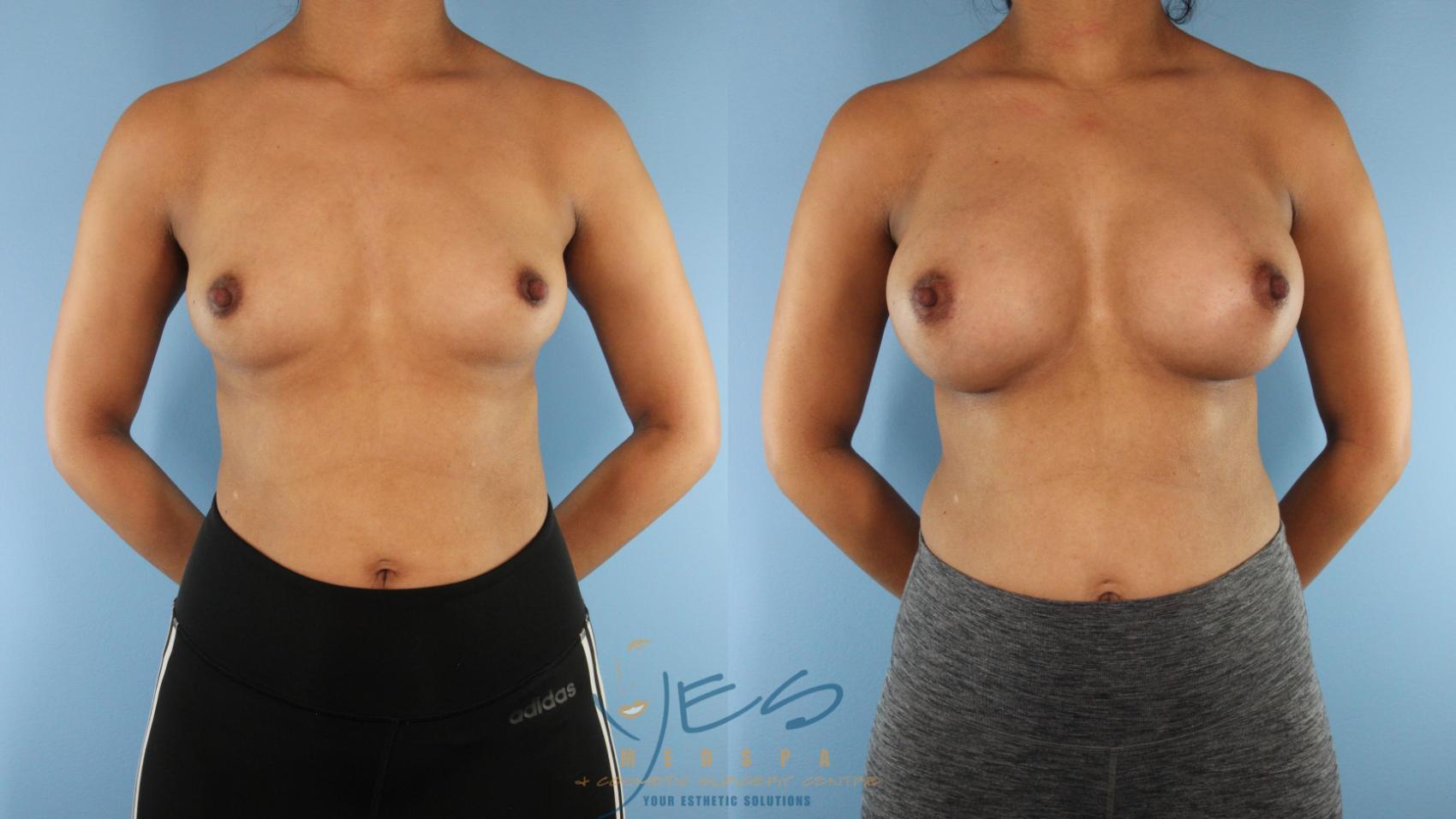 Before & After Breast Augmentation Case 577 Front View in Vancouver, BC