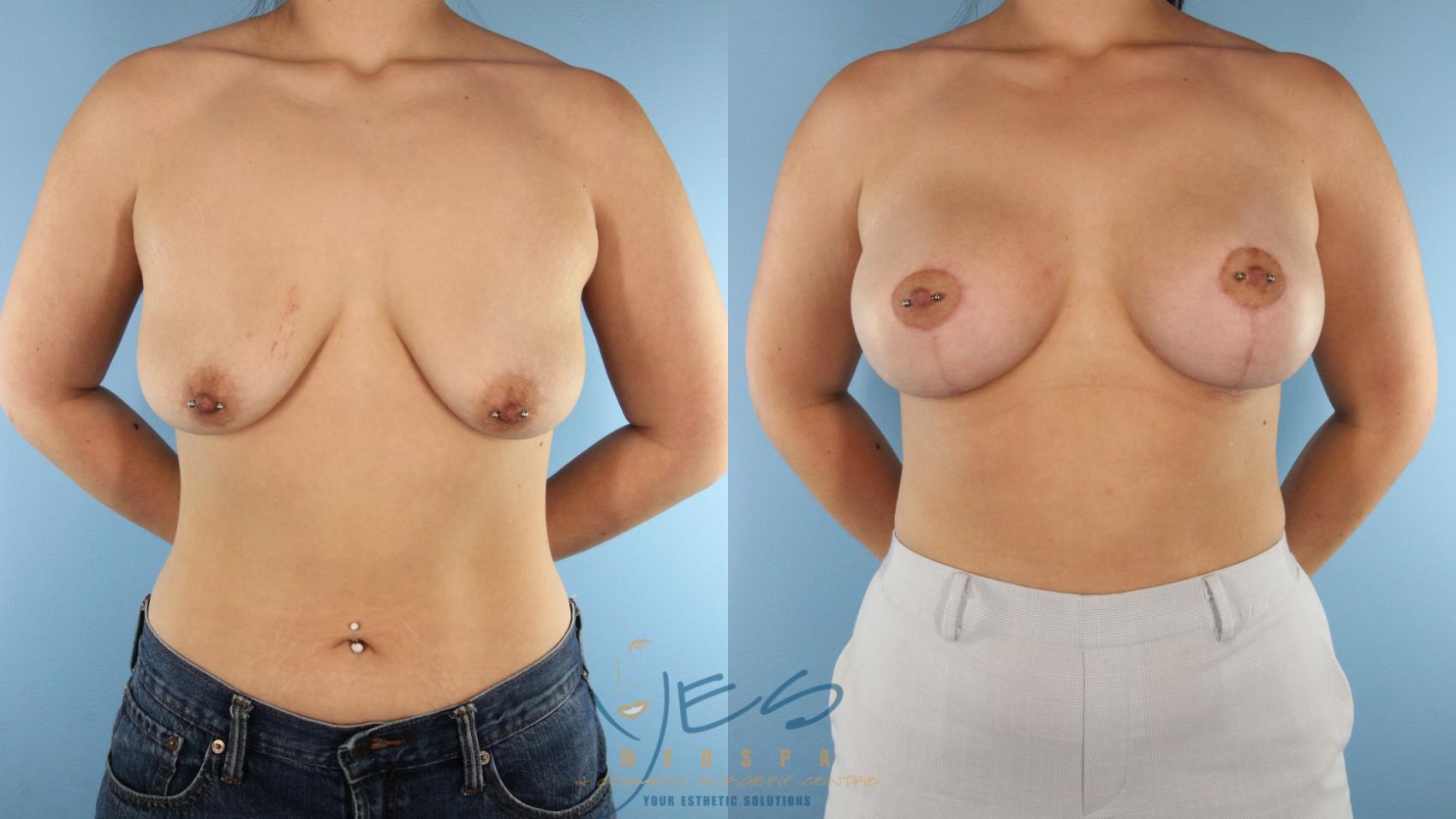 Before & After Breast Augmentation and Lift Case 565 Left Side View in Vancouver, BC