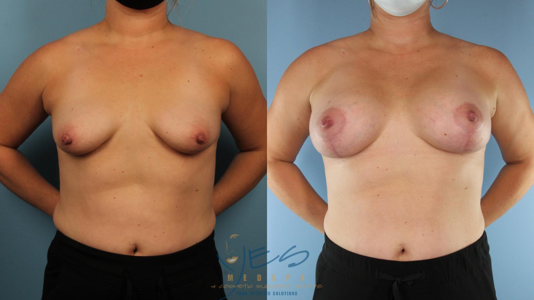 Before & After Breast Augmentation and Lift Case 566 Front View in Vancouver, BC