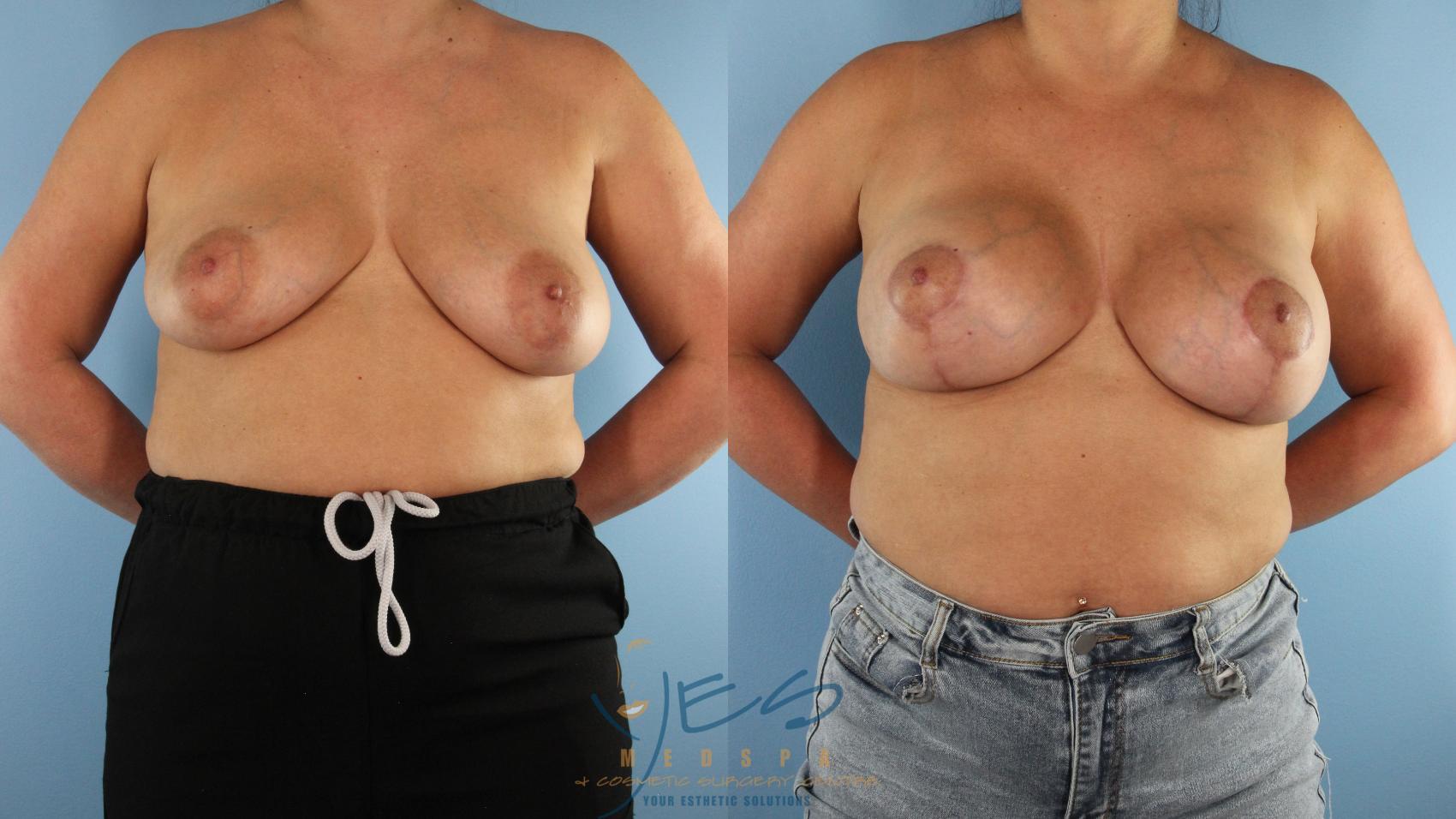 Before & After Breast Augmentation and Lift Case 567 Front View in Vancouver, BC