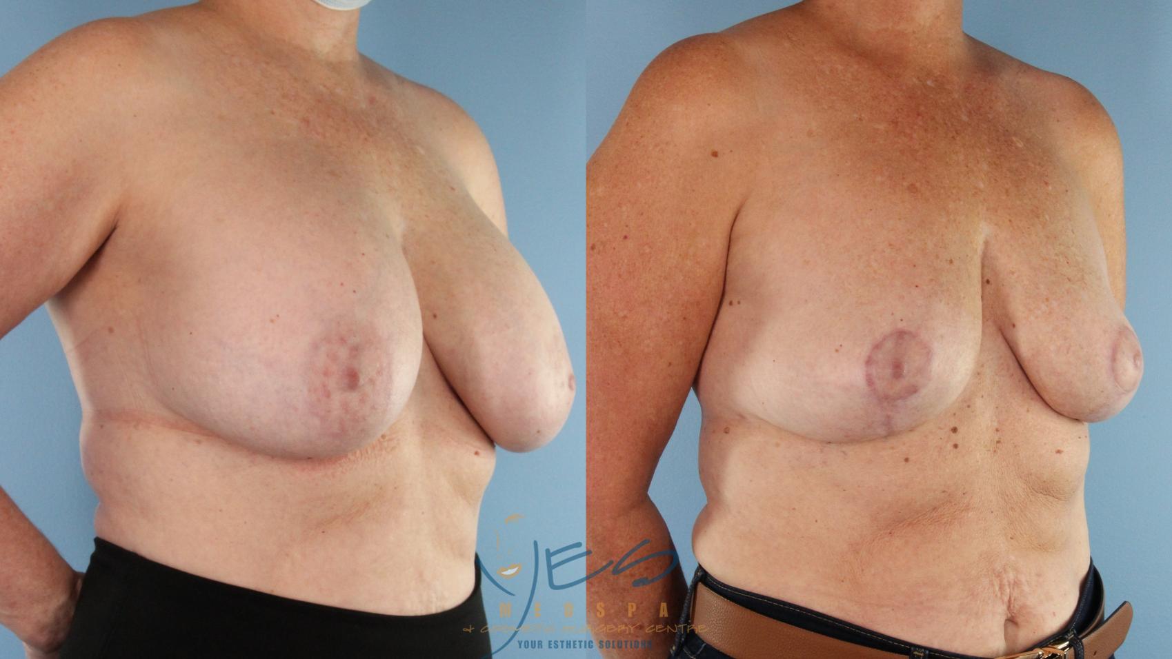 Before & After Breast Lift Case 589 Left Oblique View in Vancouver, BC