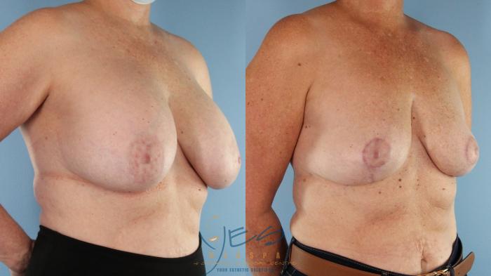 Before & After Breast Lift Case 589 Left Oblique View in Vancouver, BC