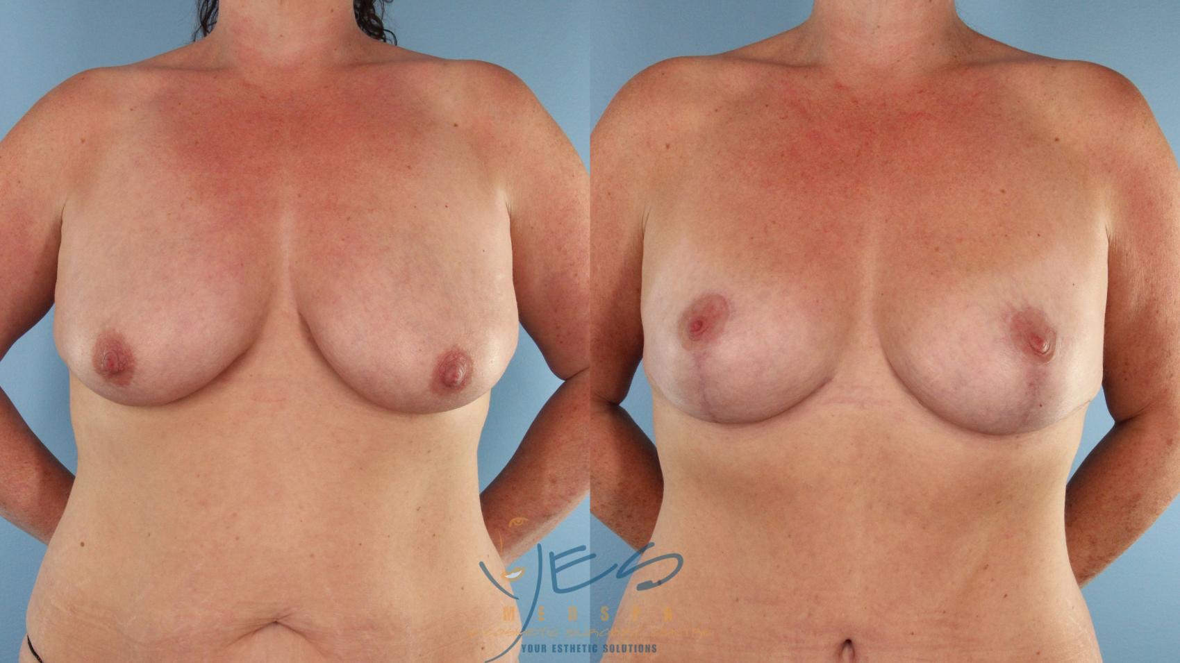 Before & After Breast Lift Case 492 Front View in Vancouver, BC