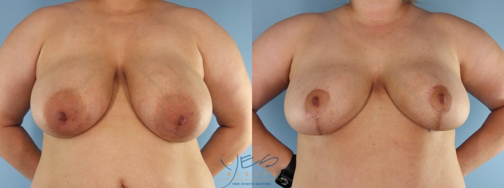 Before & After Breast Lift Case 584 Front View in Vancouver, BC