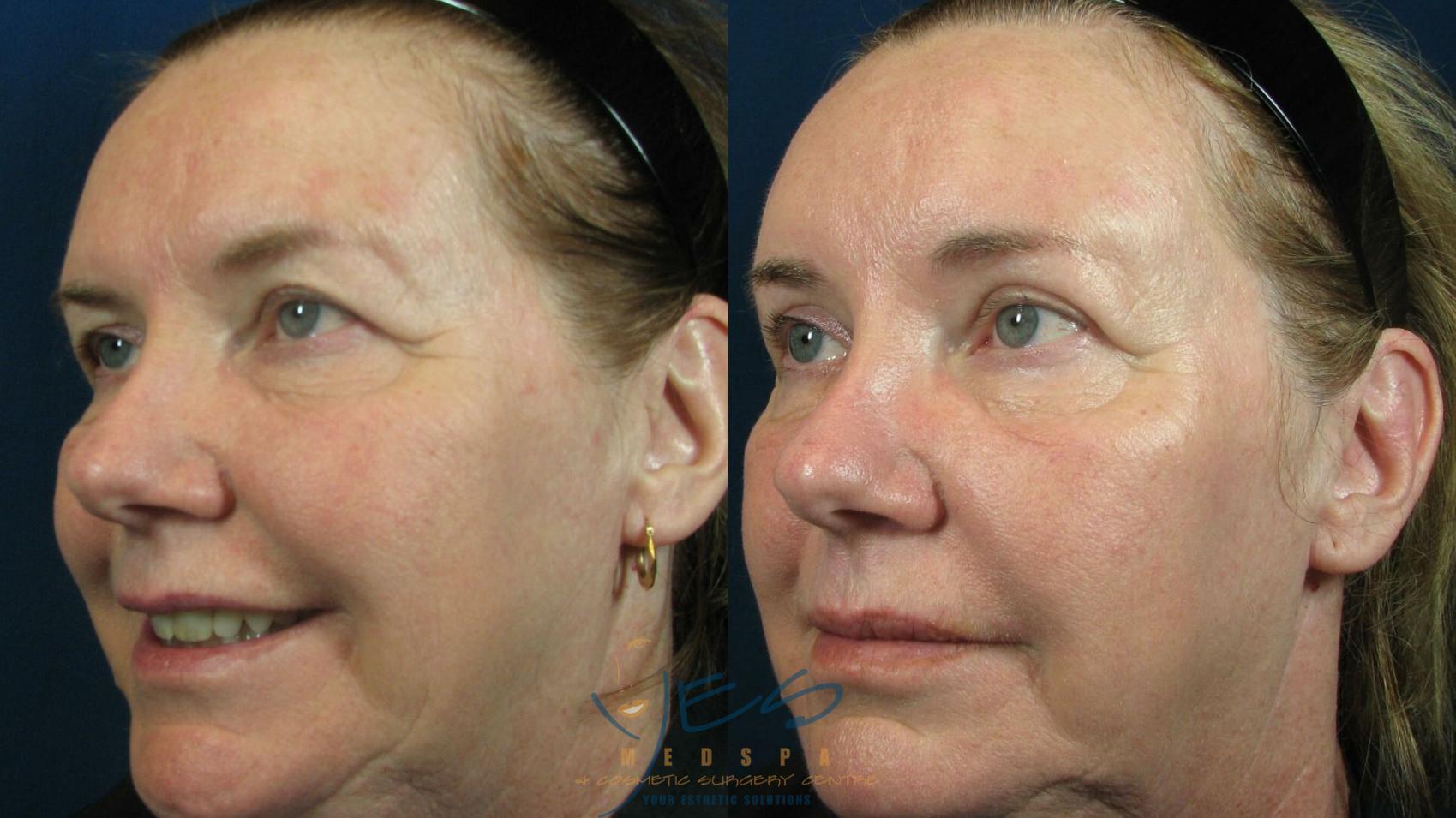 Before & After Brow Lift Case 50 View #1 View in Vancouver, BC