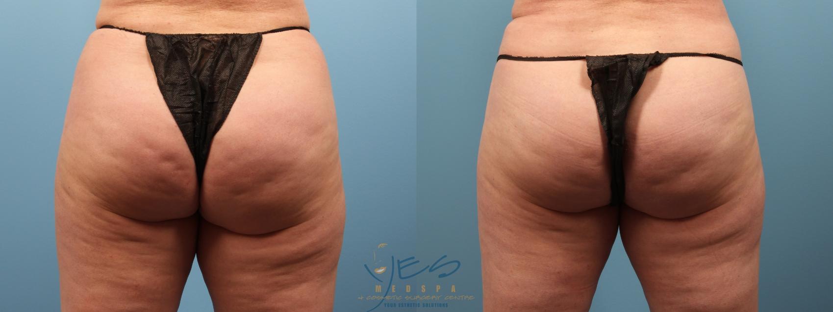 Before & After Cellulaze Case 240 Back View in Vancouver, BC