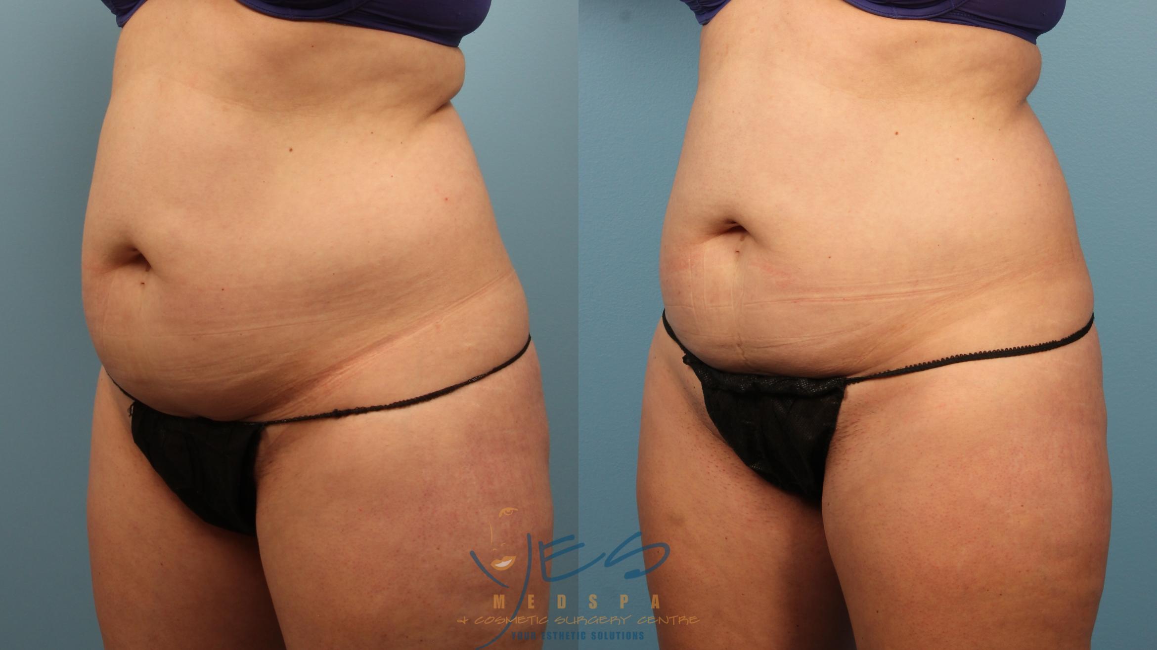 EVOLVE - TRIM Case 331 Before & After Left Oblique | Vancouver, BC | YES Medspa & Cosmetic Surgery Centre