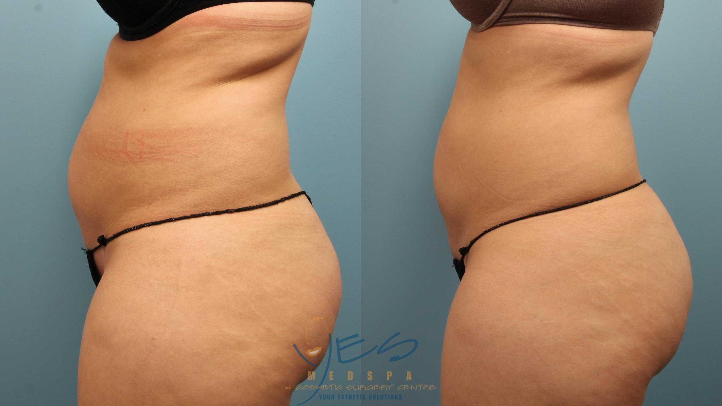 EVOLVE - TRIM Case 332 Before & After Left Side | Vancouver, BC | YES Medspa & Cosmetic Surgery Centre