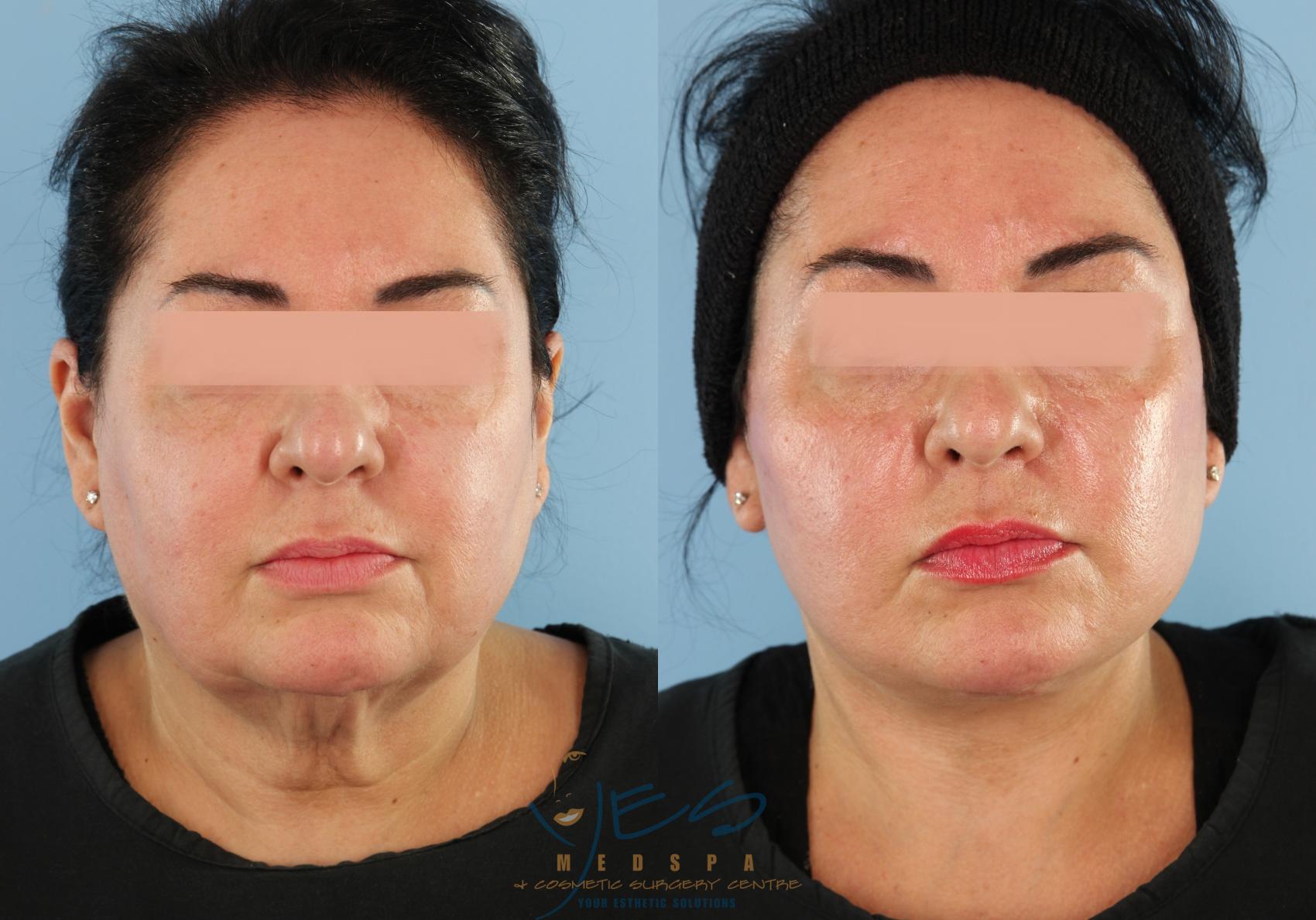 Before & After Face Lift & Neck Lift Case 582 Front View in Vancouver, BC