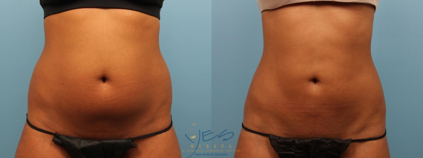 Before & After Liposuction Case 158 Front View in Vancouver, BC