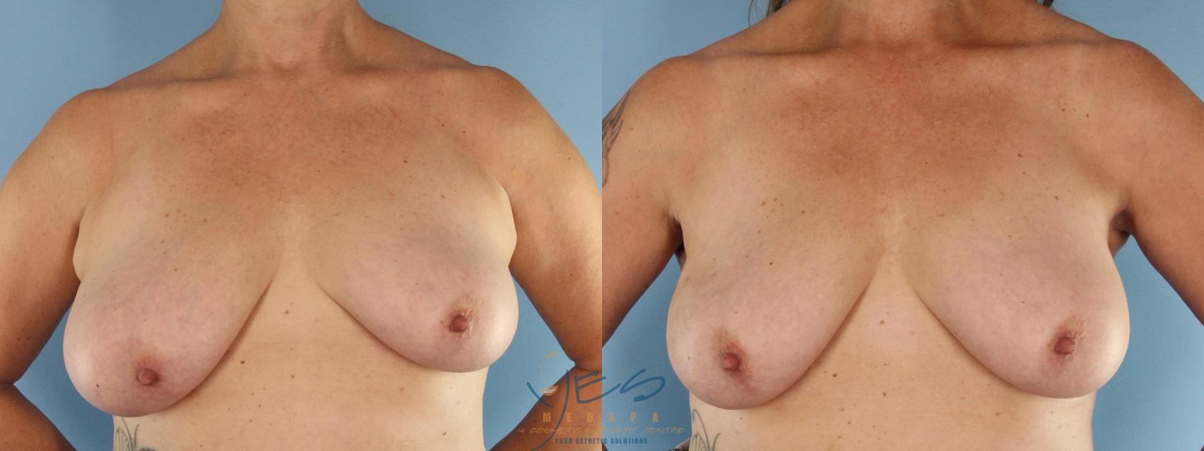 Before & After Liposuction Case 560 Front View in Vancouver, BC