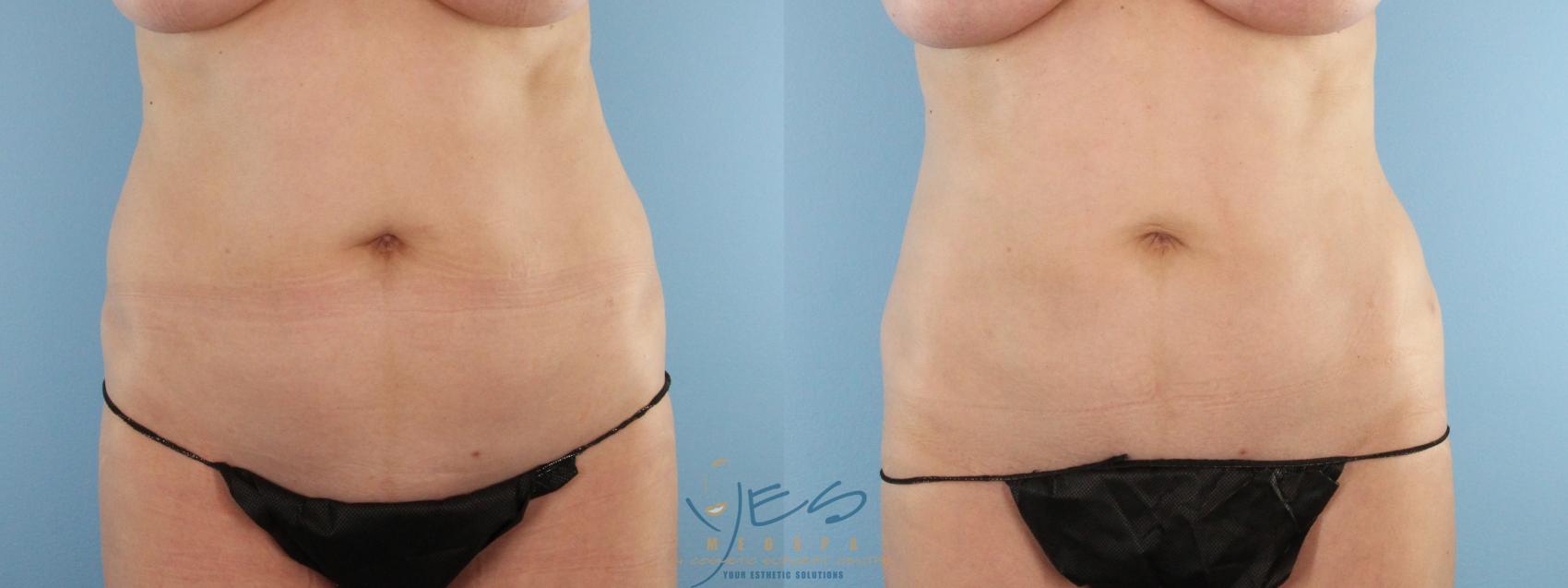 Before & After Liposuction Case 595 Front View in Vancouver, BC