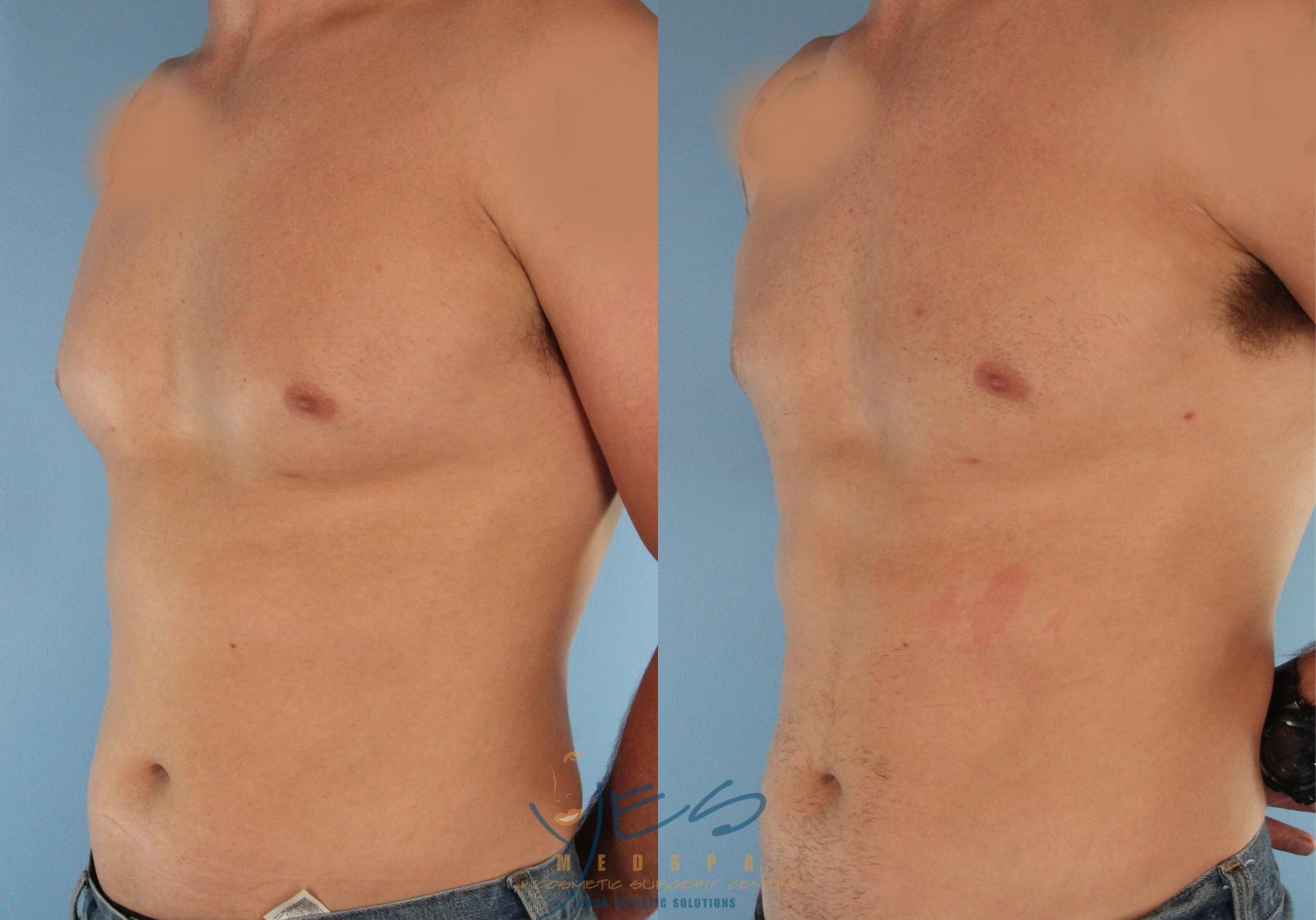 Before & After Male Breast Reduction Case 580 Left Oblique View in Vancouver, BC