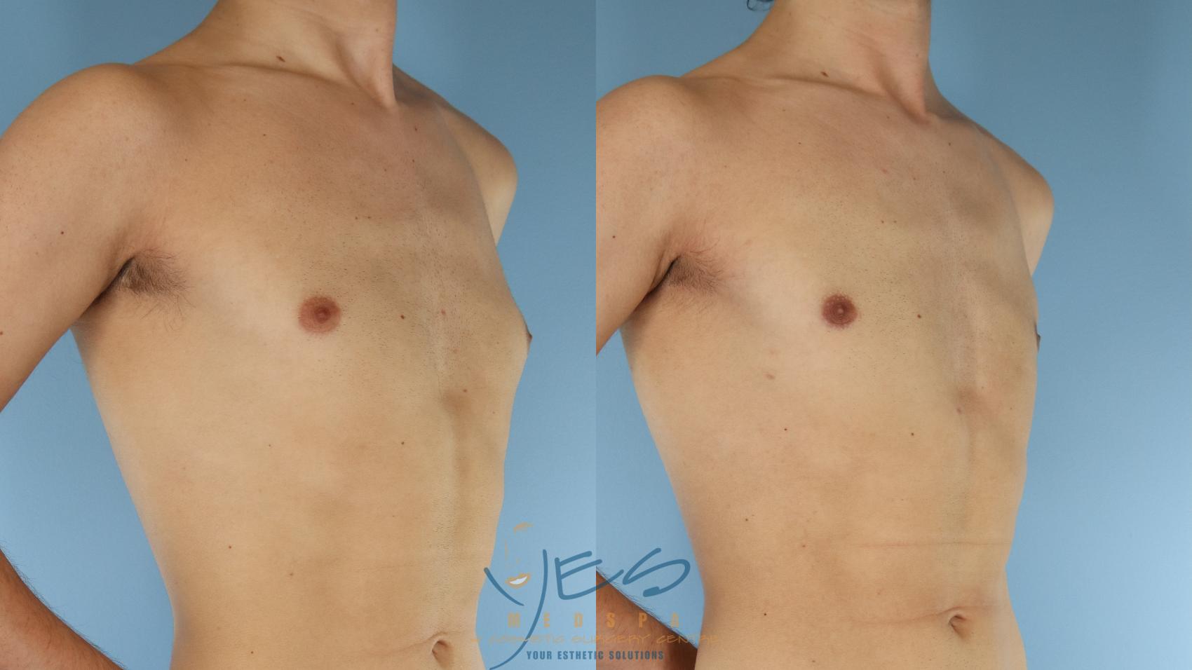 Before & After Male Breast Reduction Case 599 Right Oblique View in Vancouver, BC