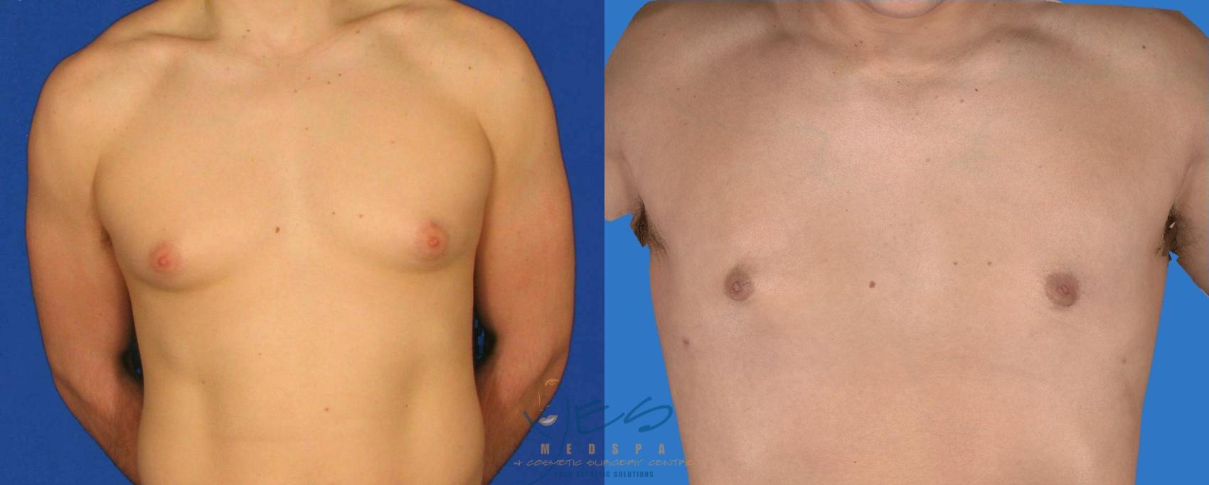 Before & After Male Breast Reduction Case 85 View #1 View in Vancouver, BC
