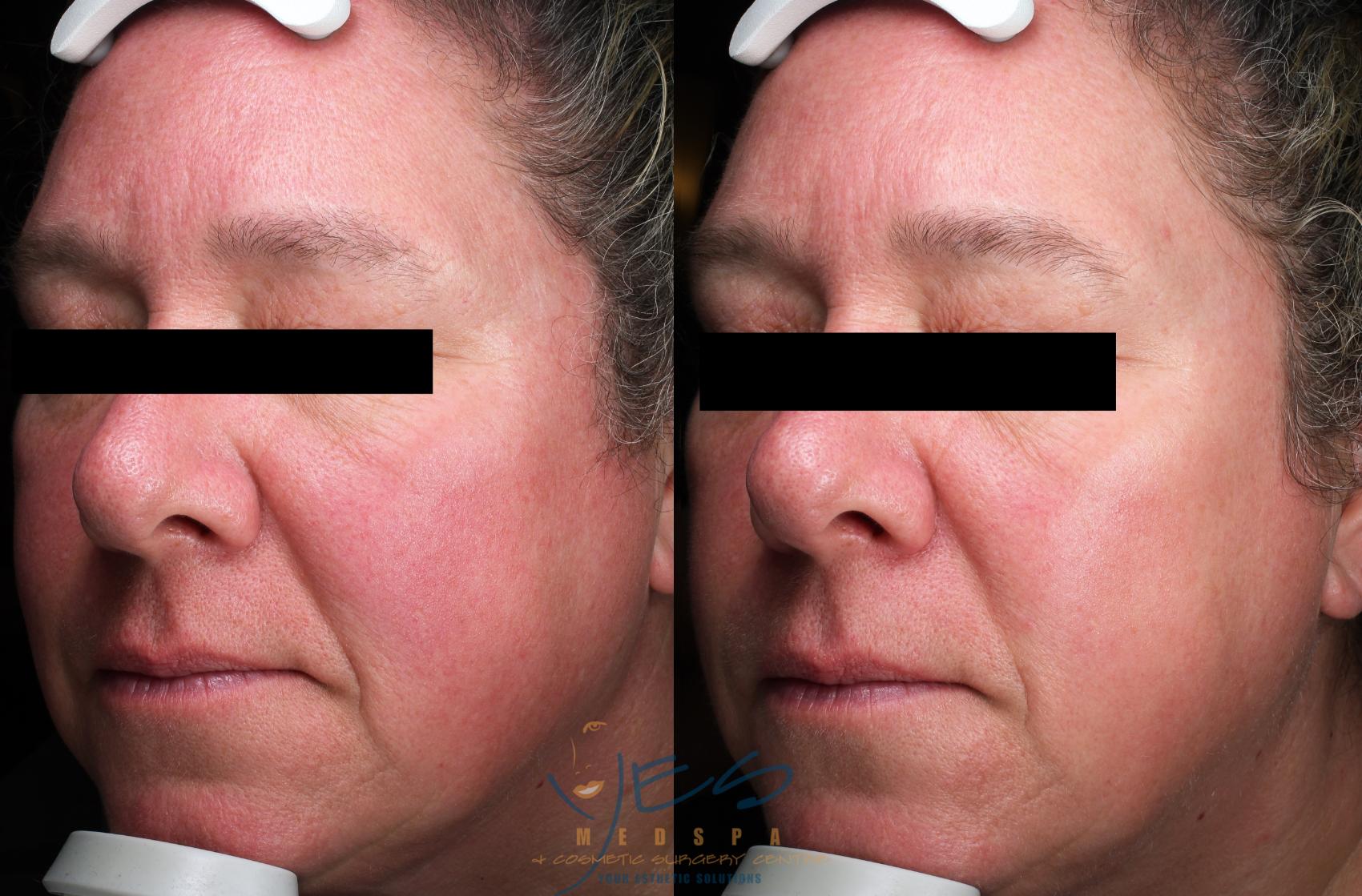 Before & After Photorejuvenation (IPL) Case 601 Left Side View in Vancouver, BC