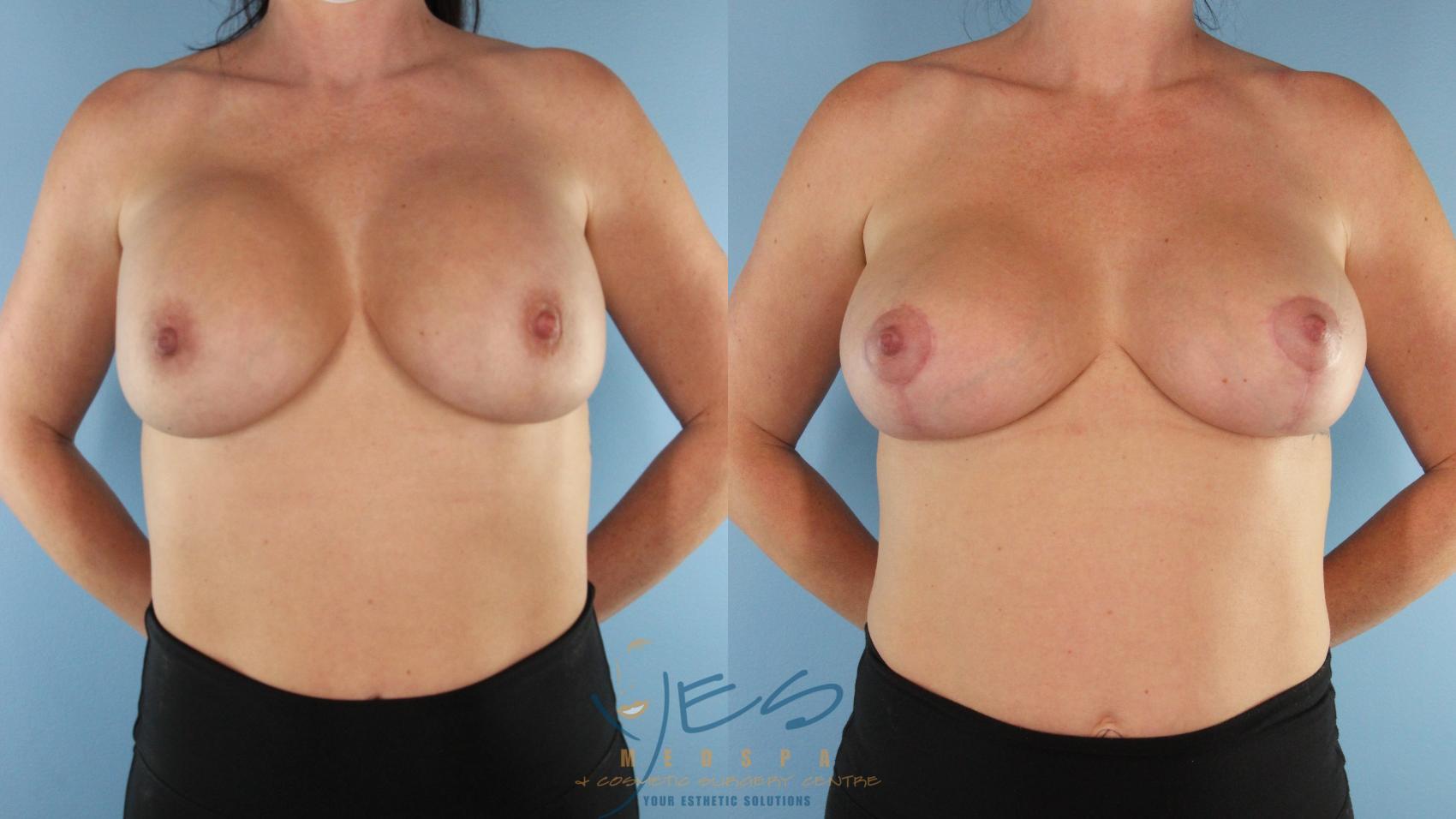 Before & After Revision Breast Surgery Case 561 Front View in Vancouver, BC