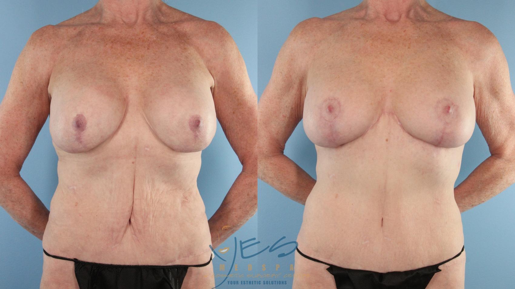 Before & After Revision Breast Surgery Case 564 Front View in Vancouver, BC