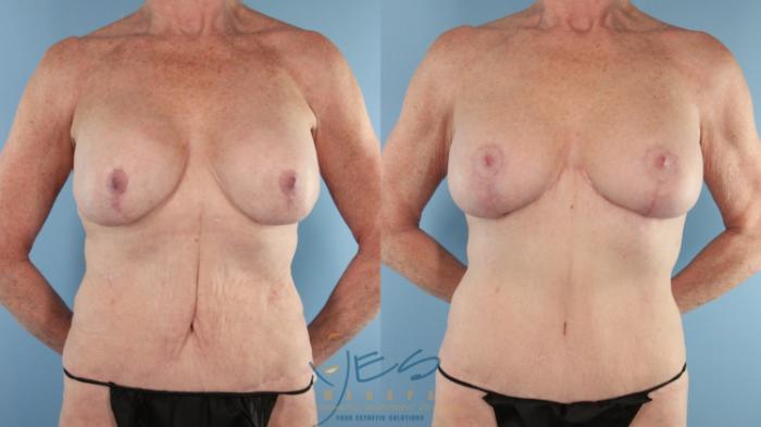 Before & After Revision Breast Surgery Case 564 Front View in Vancouver, BC