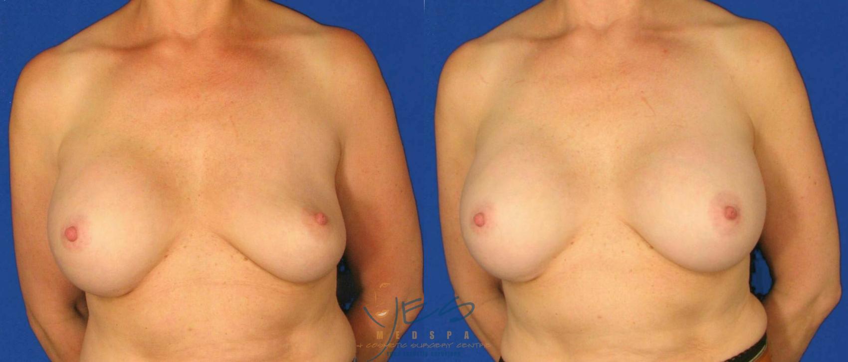 Before & After Revision Breast Surgery Case 99 View #1 View in Vancouver, BC