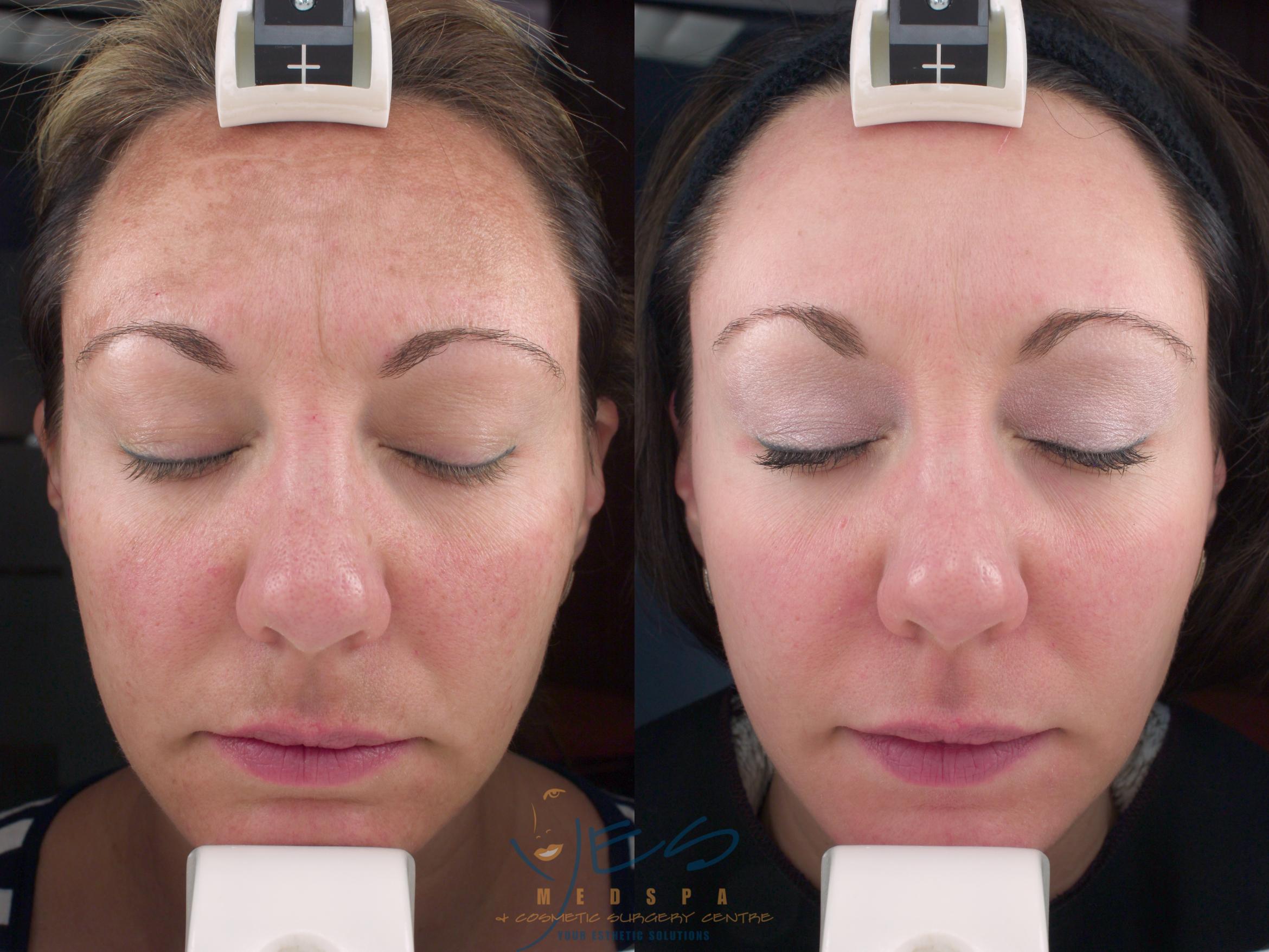 Before & After Skin Care Programs & Chemical Peels Case 207 View #1 View in Vancouver, BC