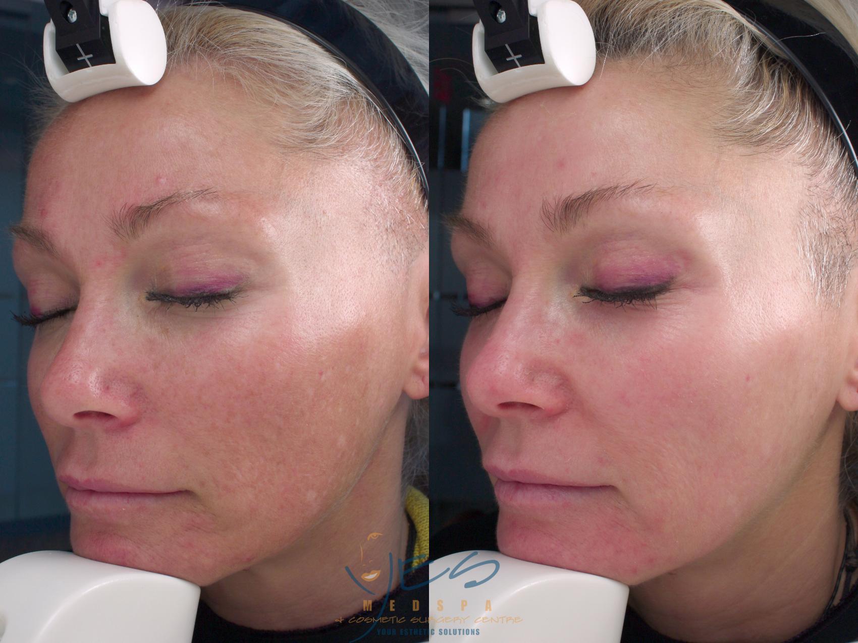Before & After Skin Care Programs & Chemical Peels Case 131 View #1 View in Vancouver, BC