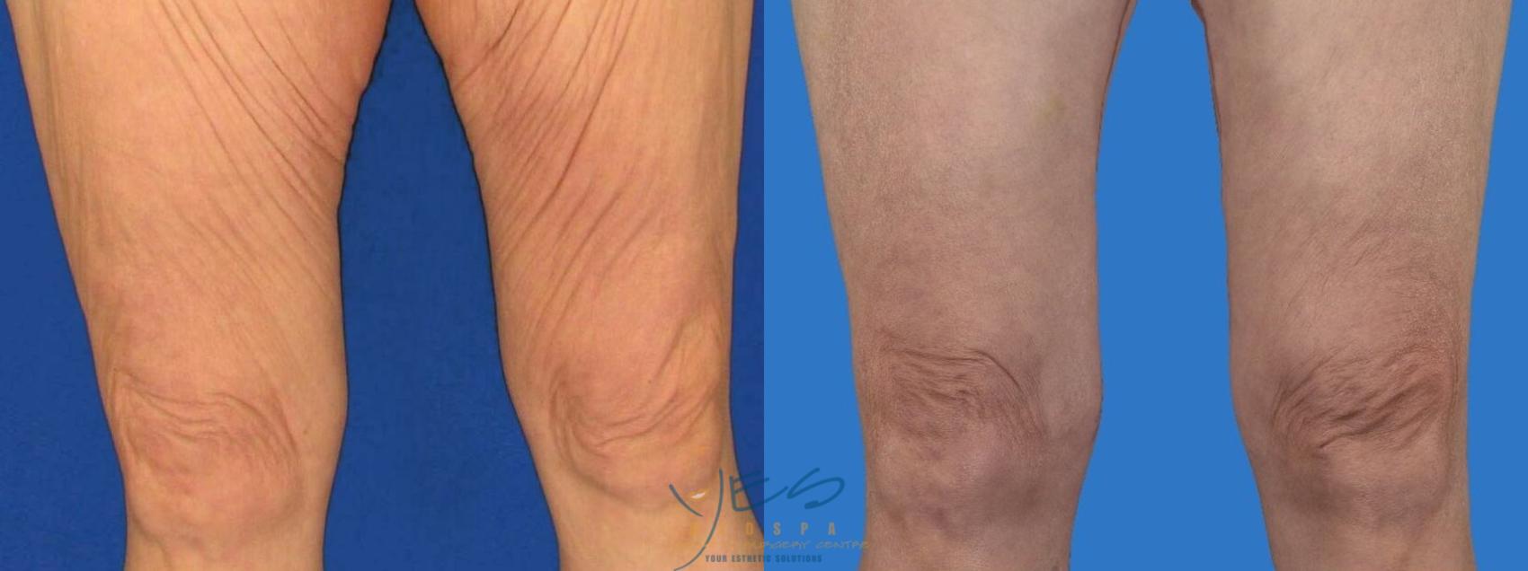 Thighplasty Case 98 Before & After Front | Vancouver, BC | YES Medspa & Cosmetic Surgery Centre