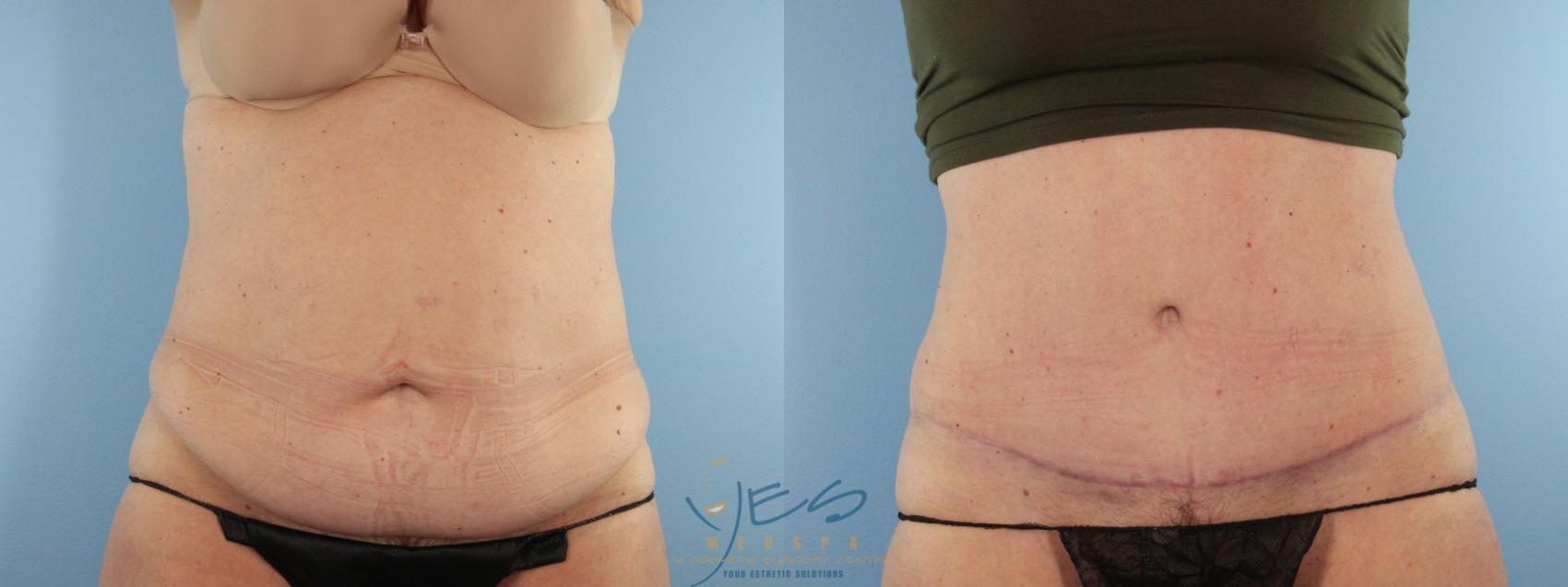 Before & After Tummy Tuck Case 581 Front View in Vancouver, BC