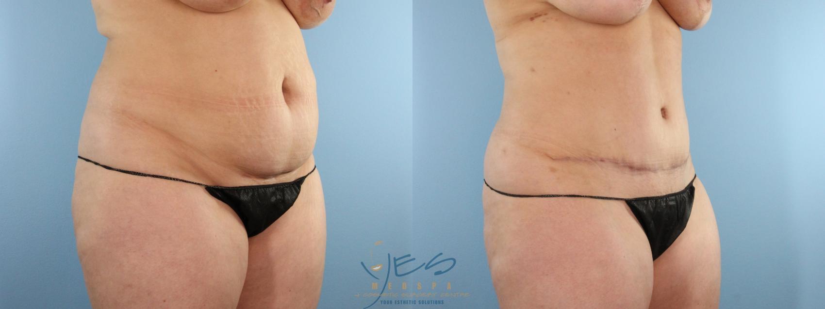 Before & After Tummy Tuck Case 585 Right Oblique View in Vancouver, BC