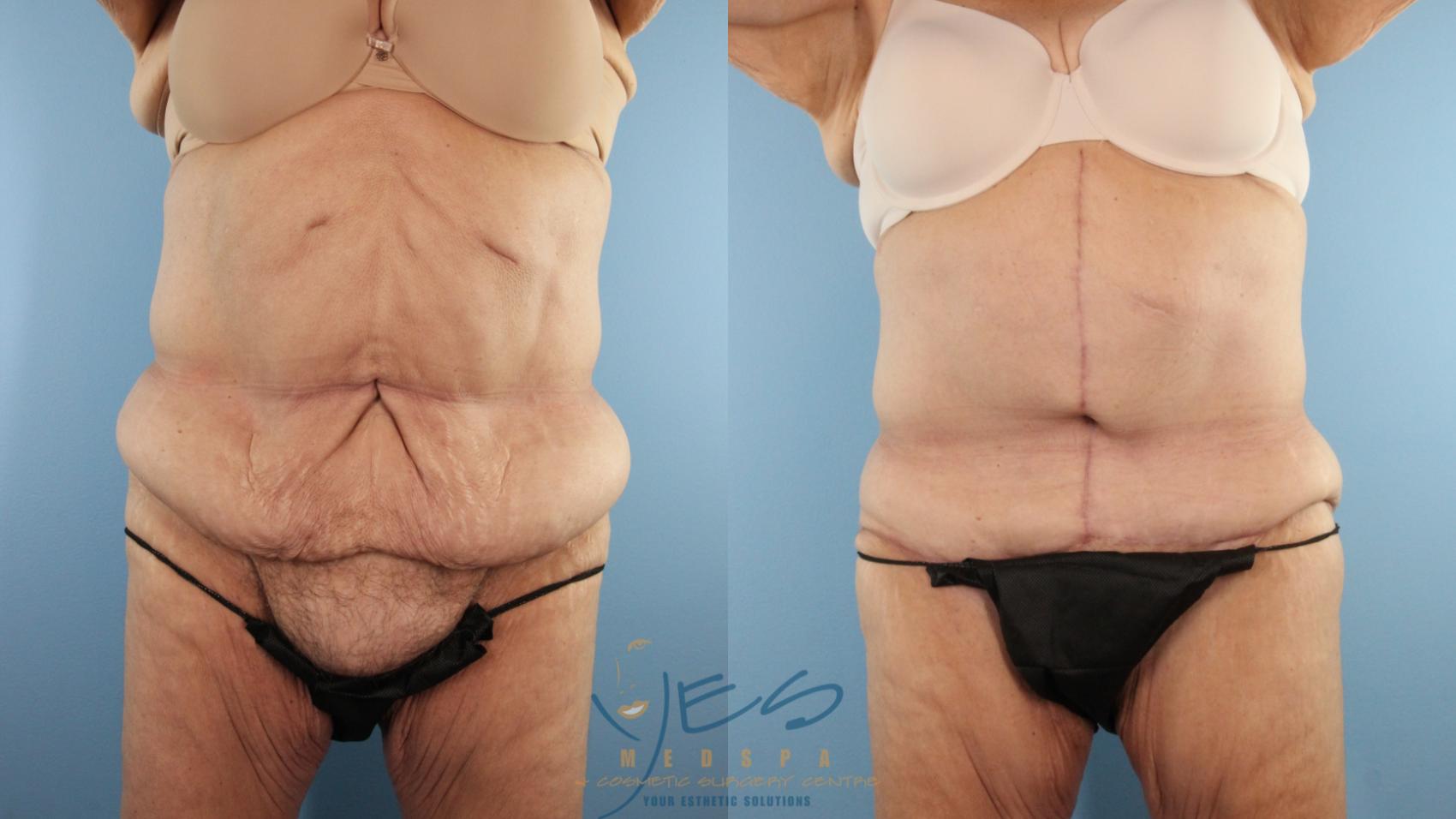 Before & After Tummy Tuck Case 596 Front View in Vancouver, BC