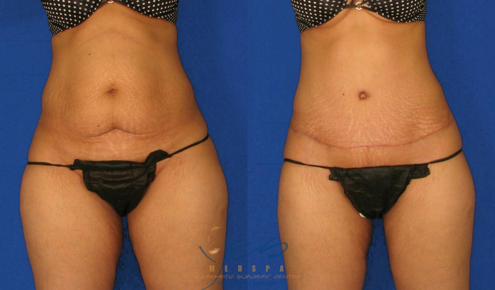 Before & After Tummy Tuck Case 90 View #1 View in Vancouver, BC