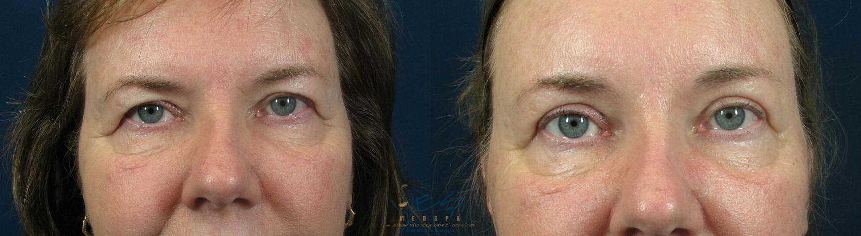 Before & After Upper Eyelid Blepharoplasty Case 59 View #1 View in Vancouver, BC