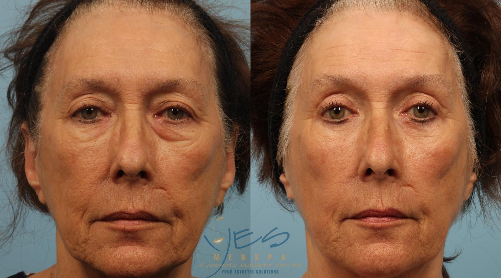 Before & After Upper & Lower Blepharoplasty Case 287 Front View in Vancouver, BC