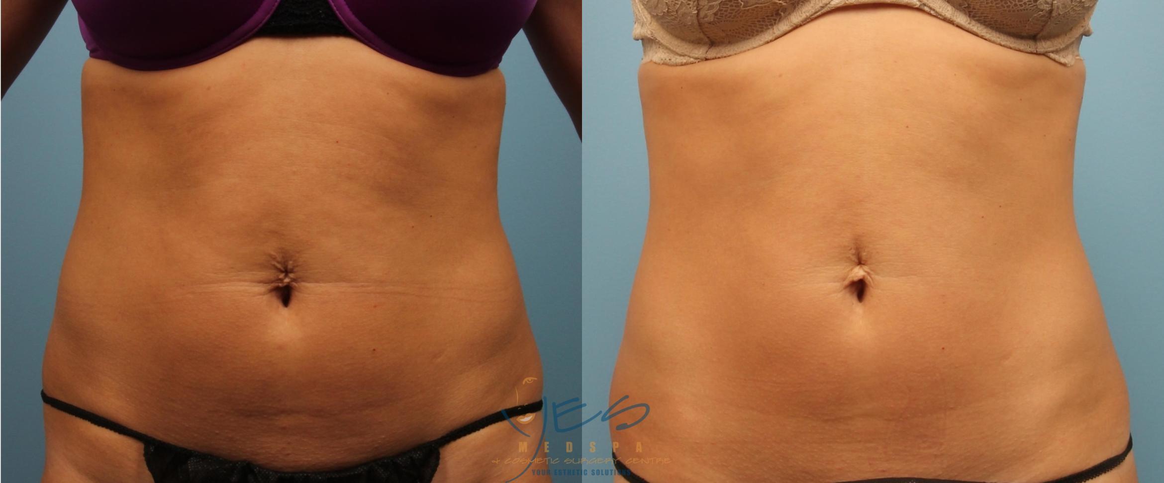 Venus Legacy Case 227 Before & After Front | Vancouver, BC | YES Medspa & Cosmetic Surgery Centre