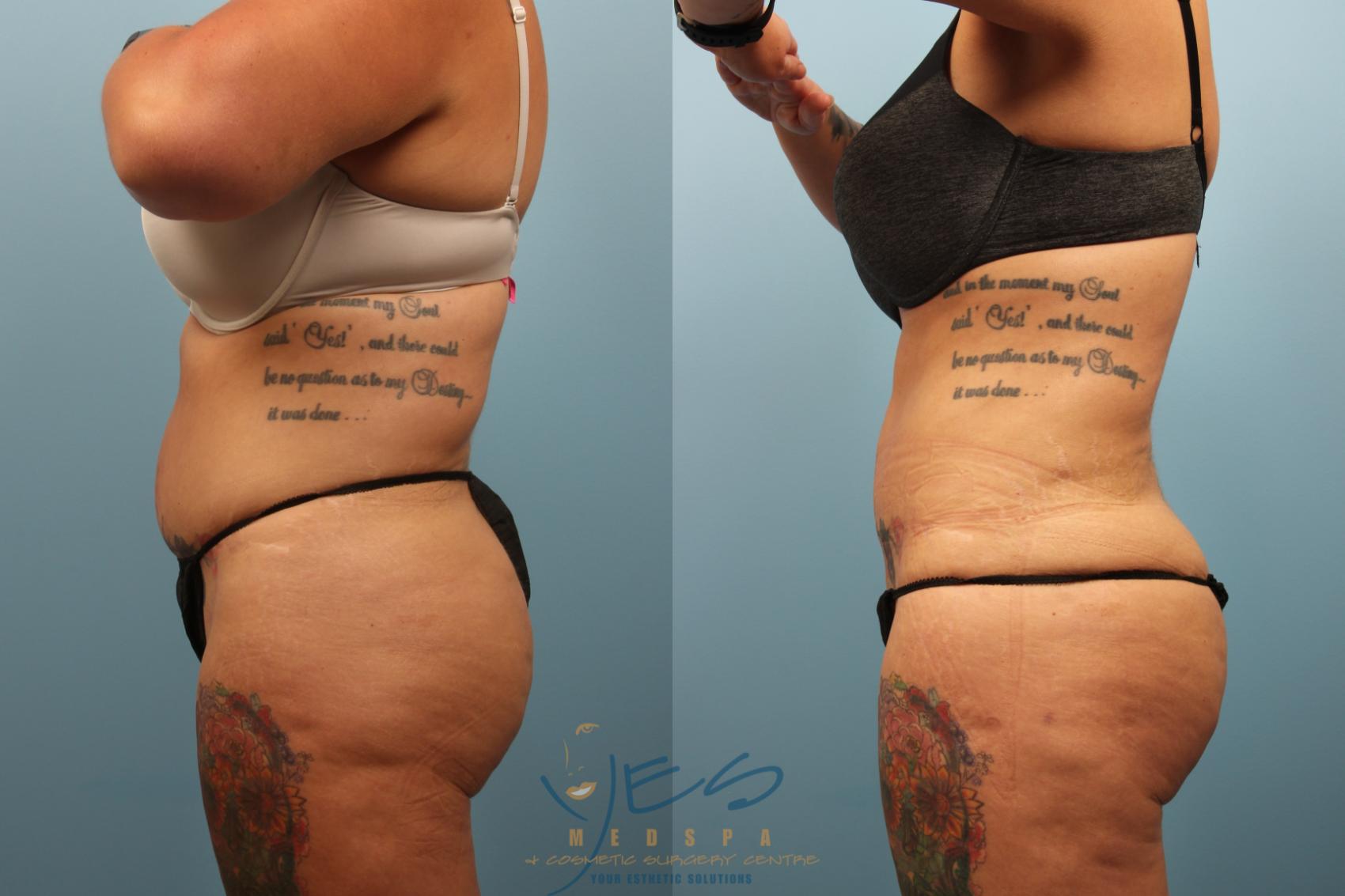 Before & After Body Fat Grafting Case 238 Left Side View in Vancouver, BC