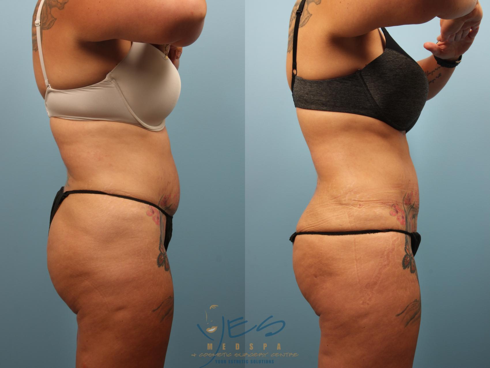 Before & After Body Fat Grafting Case 238 Right Side View in Vancouver, BC