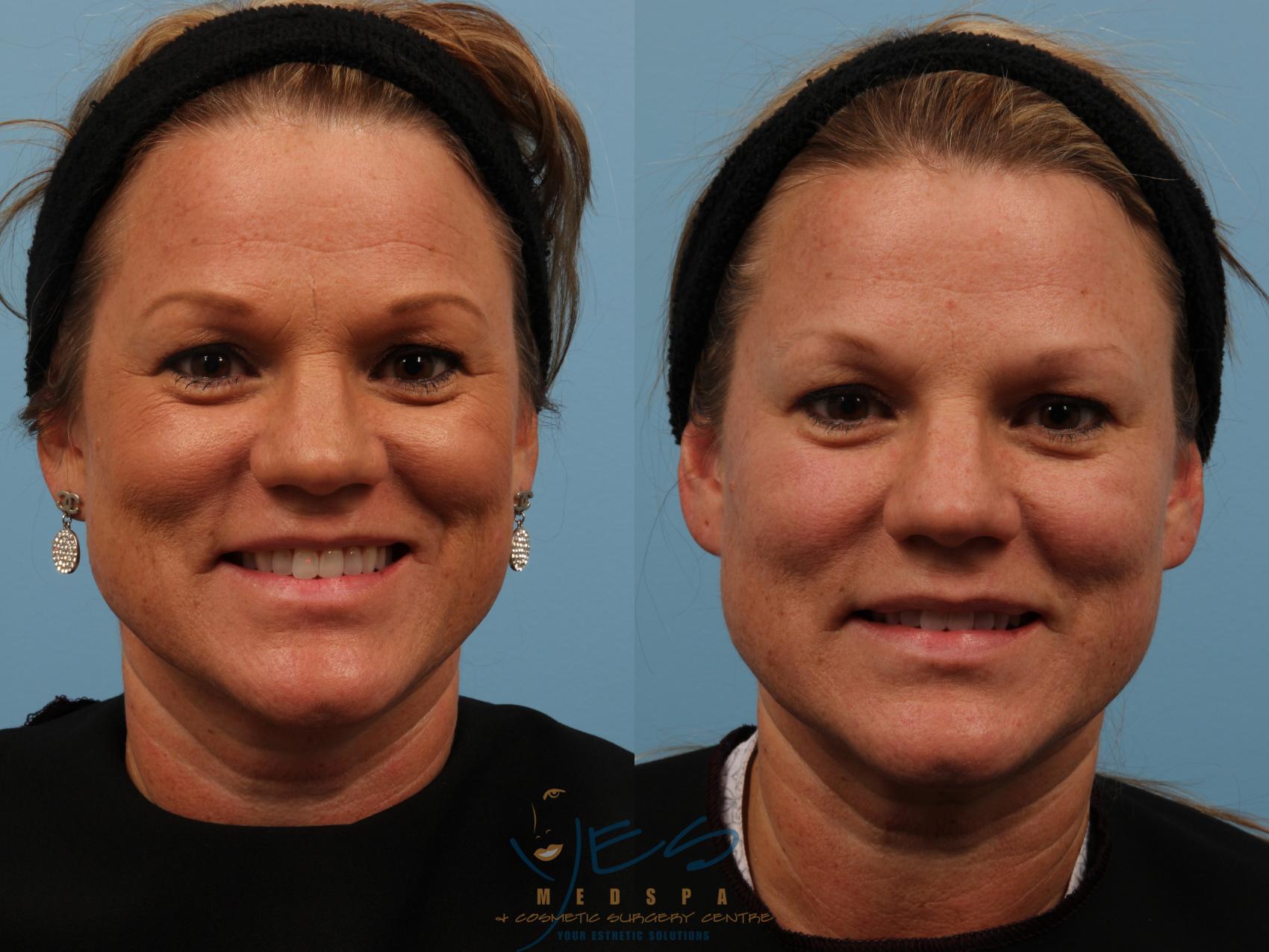 Before & After BOTOX COSMETIC® Treatments Case 129 View #1 View in Vancouver, BC