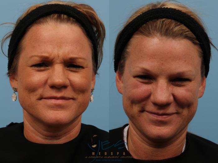 Before & After BOTOX COSMETIC® Treatments Case 129 View #2 View in Vancouver, BC