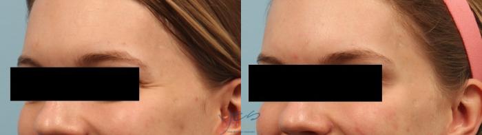 Before & After BOTOX COSMETIC® Treatments Case 250 Crowsfeet View in Vancouver, BC