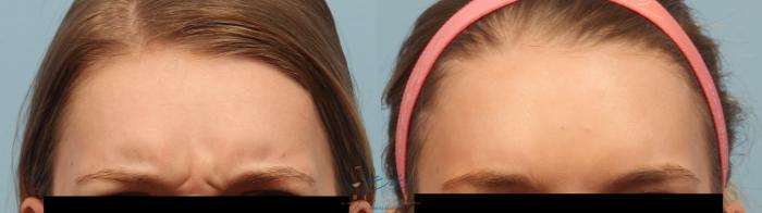 Before & After BOTOX COSMETIC® Treatments Case 250 Frown View in Vancouver, BC